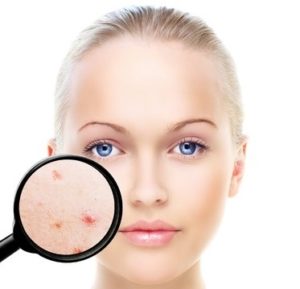 acne treatments at heaven therapy beauty rooms whitley bay and Tynemouth
