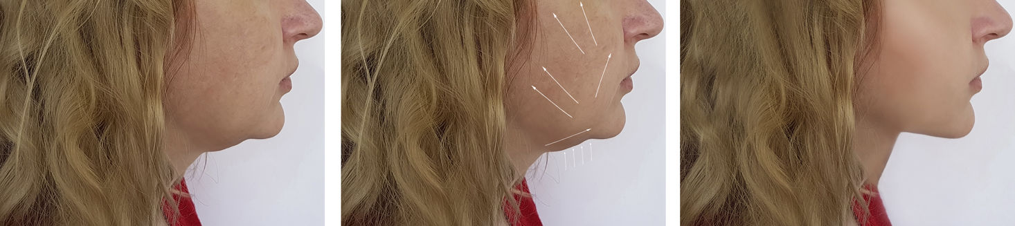 collagen lift facials near me