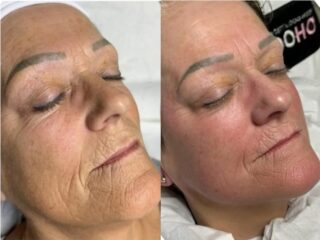 Collagen Lift Skin Tightening Treatments at Heaven Therapy Cullercoats