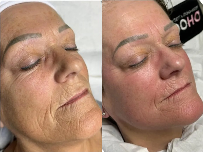 skin tightening treatment collagen before after