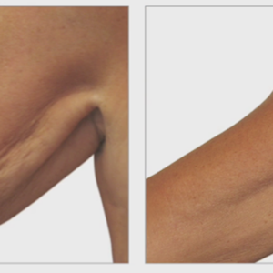 Collagen Lift Body Treatments Results of Collagen Lift Arm Firming Treatment in Cullercoats