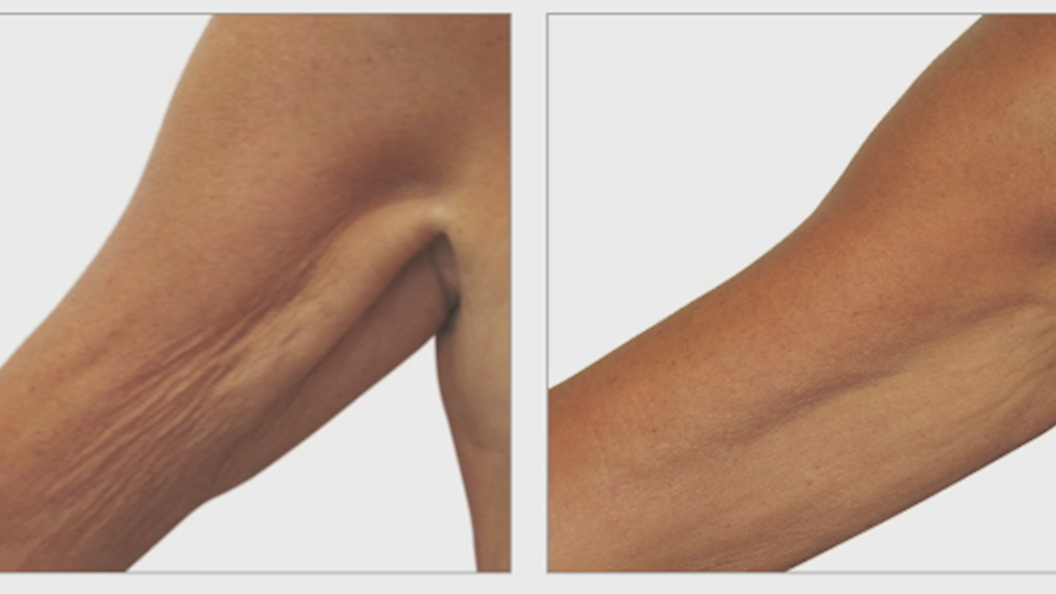 Arm Tightening Treatment at Heaven Therapy Beauty Salon in Cullercoats