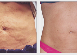 Collagen Lift Body Treatments Results of Collagen lift Stomach tightening at Heaven Therapy
