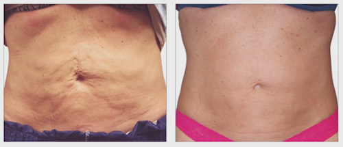 Stomach Tightening Treatment at Heaven Therapy Beauty Salon in Cullercoats