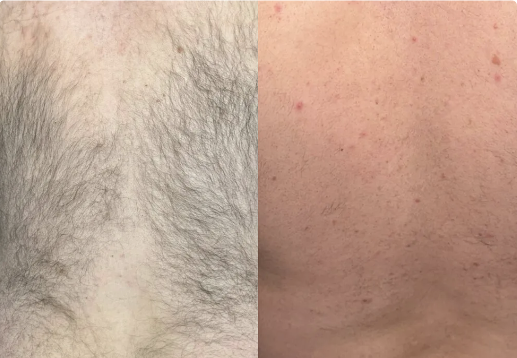 ipl hair removal before after IPL Back Treatment Before and After at Heaven Therapy Beauty Salon Cullercoats